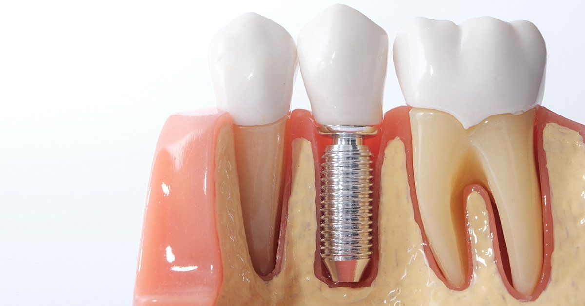 dental implants