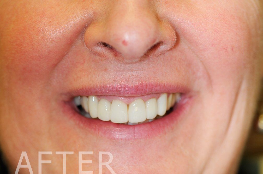porcelain veneers after