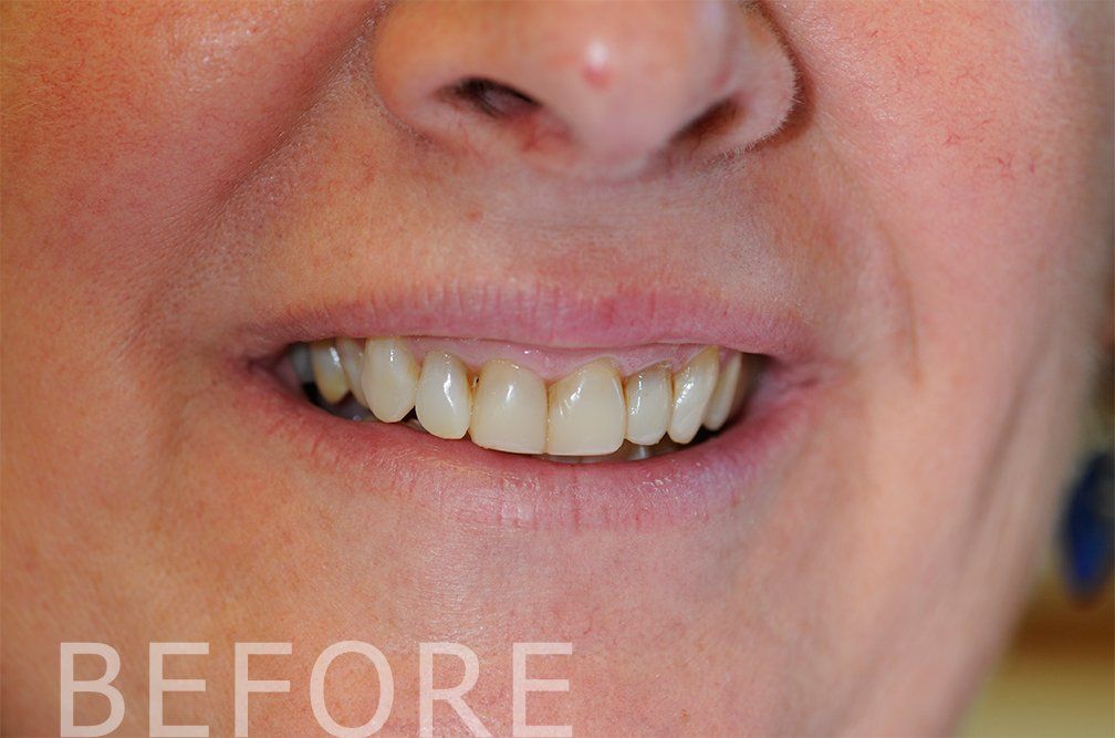 procelain veneers before