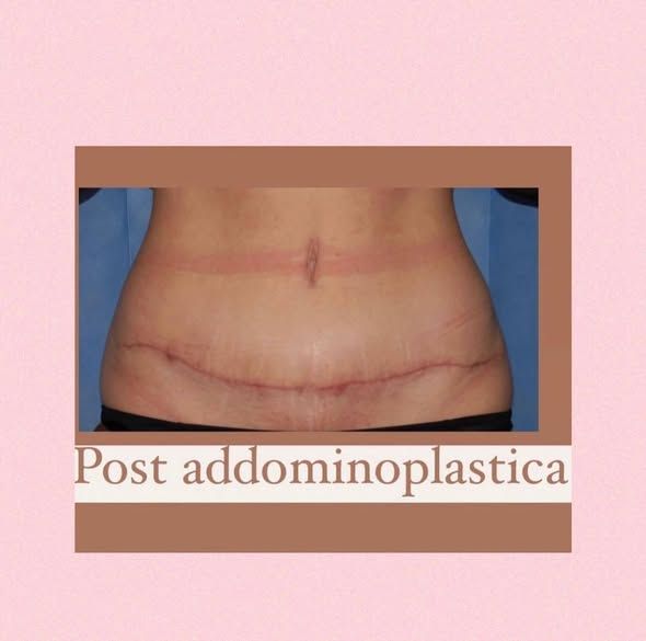 Cosa accade dopo un parto cesareo o un'intervento di addominoplastica?