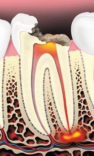 Infected Tooth — Hudsonville, MI — Hudsonville Family Dentistry