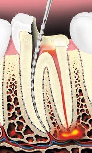 Tooth Decay Removed — Hudsonville, MI — Hudsonville Family Dentistry