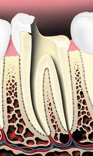Cleaned Shape And Disinfected Tooth — Hudsonville, MI — Hudsonville Family Dentistry