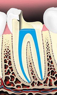 Root Canals And Pulp Chamber — Hudsonville, MI — Hudsonville Family Dentistry