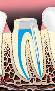 Metal Rod May Be Placed In The Root Canal — Hudsonville, MI — Hudsonville Family Dentistry