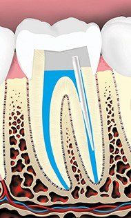 Crown Of The Tooth Restored — Hudsonville, MI — Hudsonville Family Dentistry
