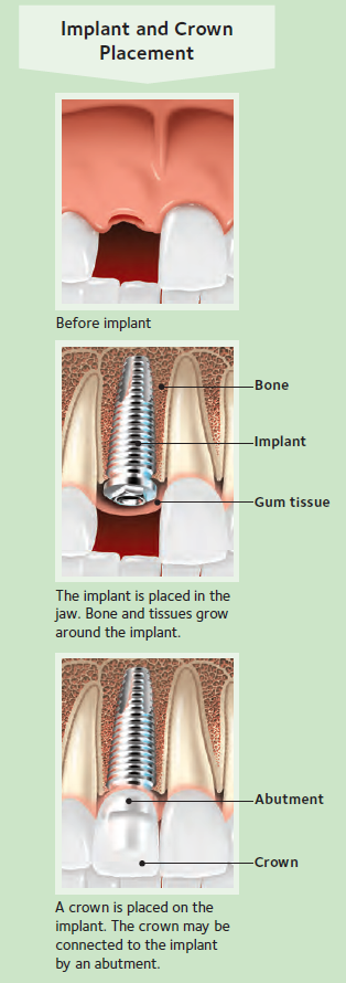 Implant And Crown Placement — Hudsonville, MI — Hudsonville Family Dentistry