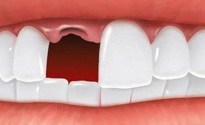 Missing Tooth — Hudsonville, MI — Hudsonville Family Dentistry