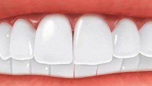 Missing Tooth Replaced By Dental Implant — Hudsonville, MI — Hudsonville Family Dentistry