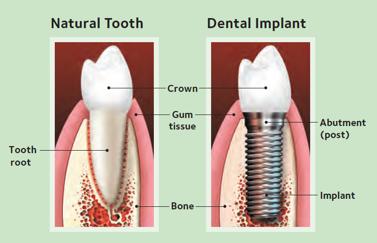 Natural Tooth And Dental Implant — Hudsonville, MI — Hudsonville Family Dentistry