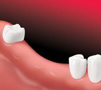 Missing Teeth — Hudsonville, MI — Hudsonville Family Dentistry