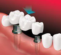 Bridge Is Placed On Implants — Hudsonville, MI — Hudsonville Family Dentistry