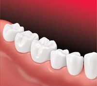 After The Bridge Is Placed — Hudsonville, MI — Hudsonville Family Dentistry