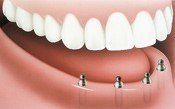 With Implants — Hudsonville, MI — Hudsonville Family Dentistry