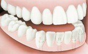After Dental Implant — Hudsonville, MI — Hudsonville Family Dentistry
