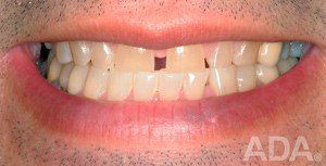 Smiling With Teeth Separated — Hudsonville, MI — Hudsonville Family Dentistry