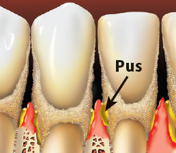 Teeth With Pus — Hudsonville, MI — Hudsonville Family Dentistry