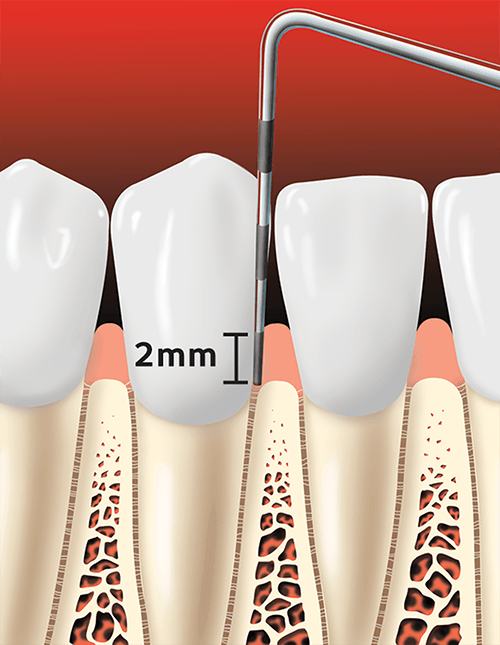 Teeth With 2mm Pocket Depth — Hudsonville, MI — Hudsonville Family Dentistry
