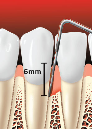 Teeth With 6mm Pocket Depth — Hudsonville, MI — Hudsonville Family Dentistry