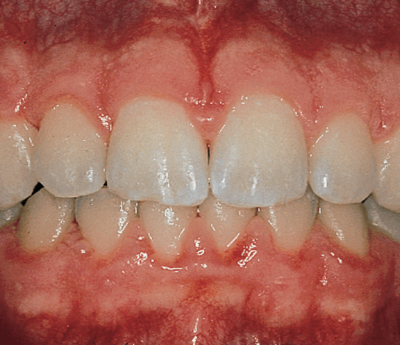 Gingivitis — Hudsonville, MI — Hudsonville Family Dentistry