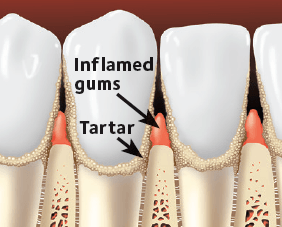 Inflamed Gums And Tartar — Hudsonville, MI — Hudsonville Family Dentistry
