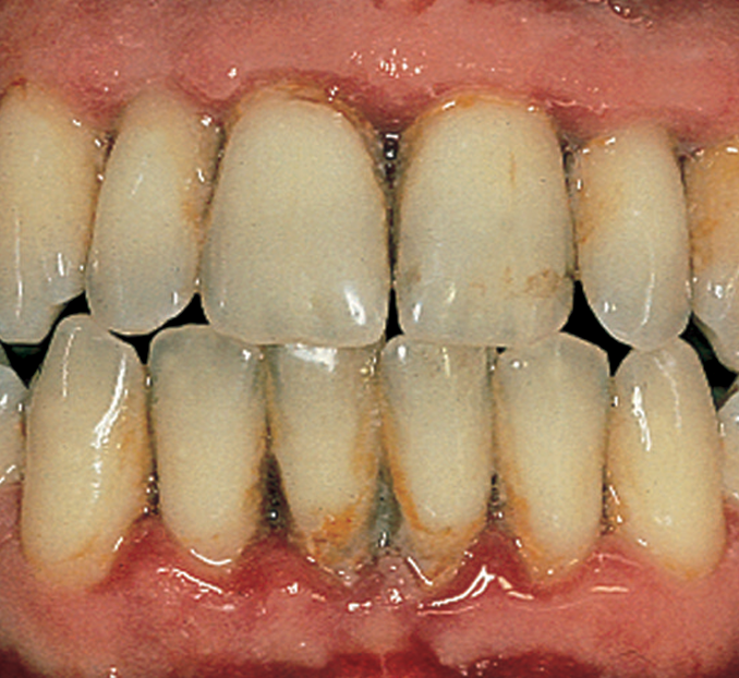 Periodontitis — Hudsonville, MI — Hudsonville Family Dentistry