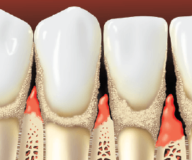 Teeth With Tartar — Hudsonville, MI — Hudsonville Family Dentistry