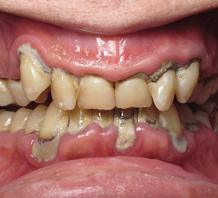 Advanced Periodontitis — Hudsonville, MI — Hudsonville Family Dentistry