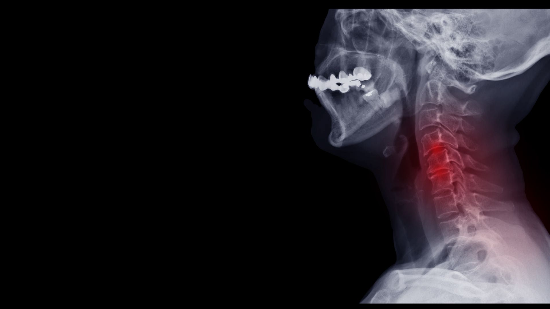 X-ray Of Neck And Cervical Spine Side View — Lumberton, NJ — Advanced Back And Neck Care