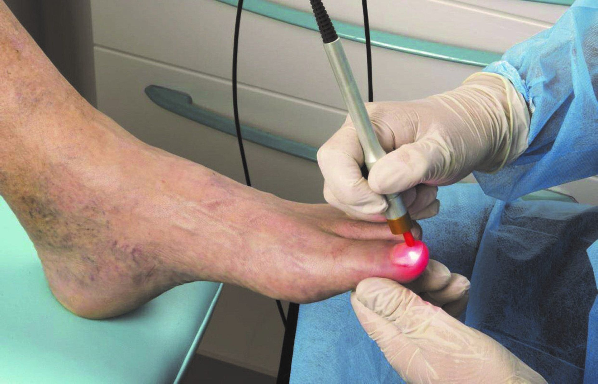 trattamento laser