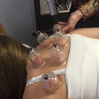 A woman is getting a cupping treatment on her back