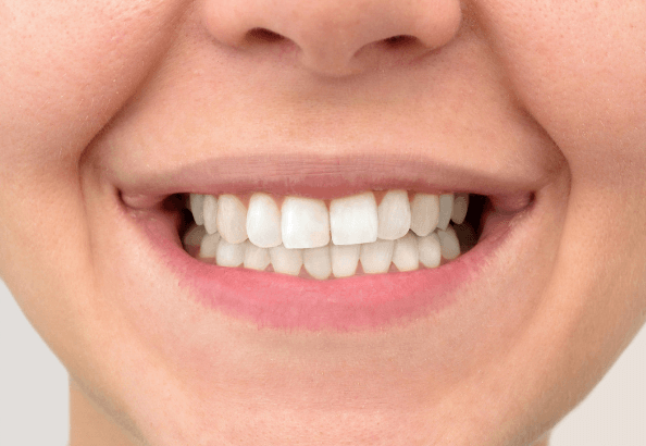 A close up of a woman 's smile with white teeth.