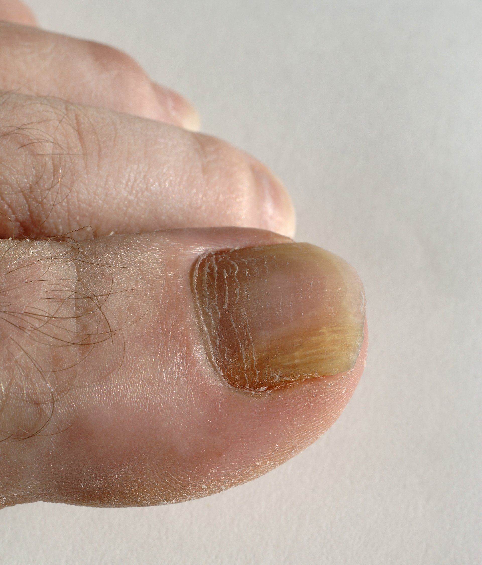 Feet With Fungal Nails — Brockton, MA — JW Podiatry