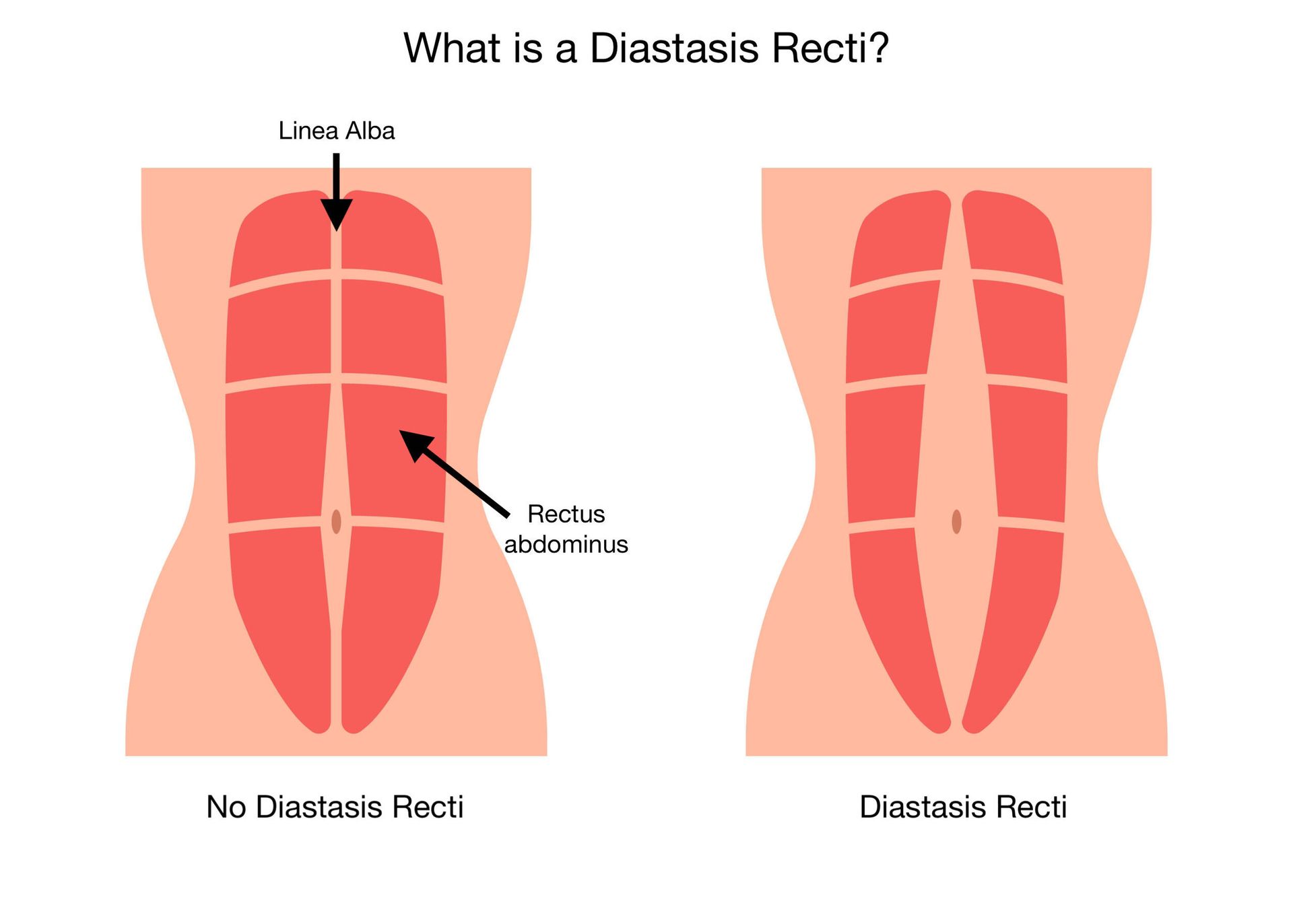 A diagram showing what is a diastasis recti