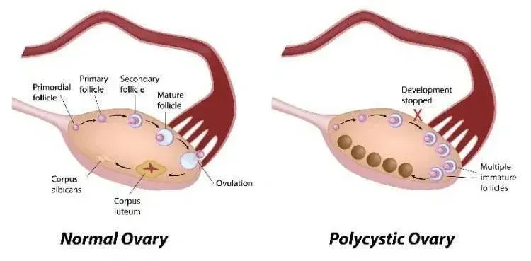 Polycystic Ovarian Syndrome (PCOS)