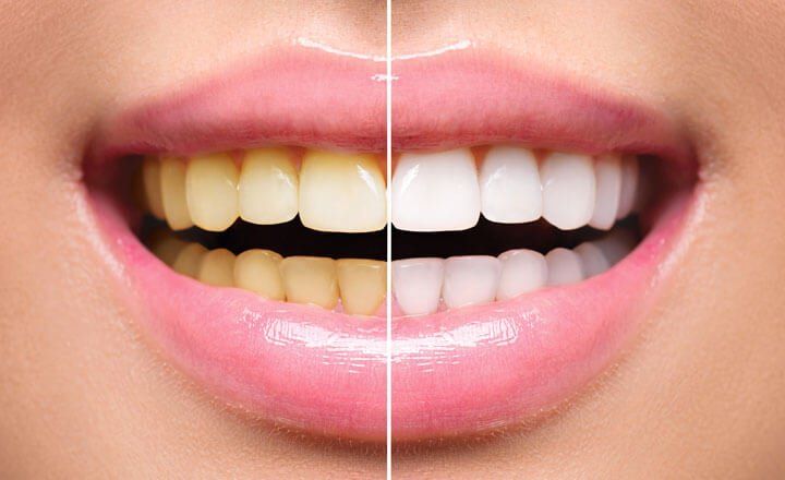 Sbiancamento dentale - Centro medico Smile San Marino