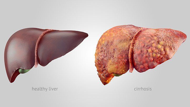 A healthy liver and a liver with cirrhosis on a gray background.