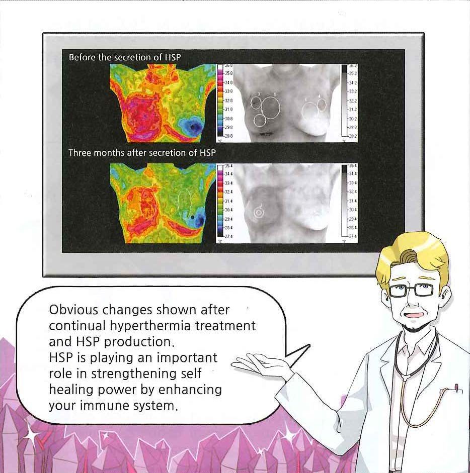 A doctor is talking about changes shown after a hyperthermia treatment