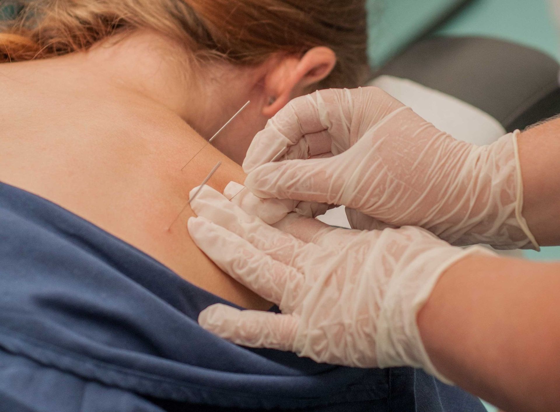 Dry needling therapy 