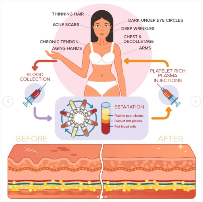 PRP and Skin process infograph