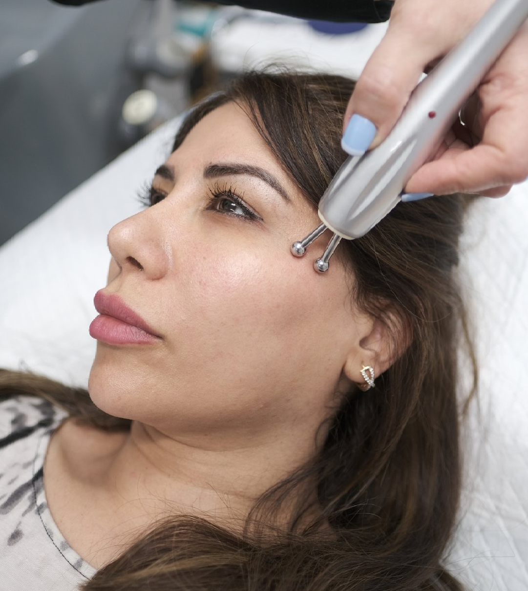 woman getting radiofrequency treatment around eyes