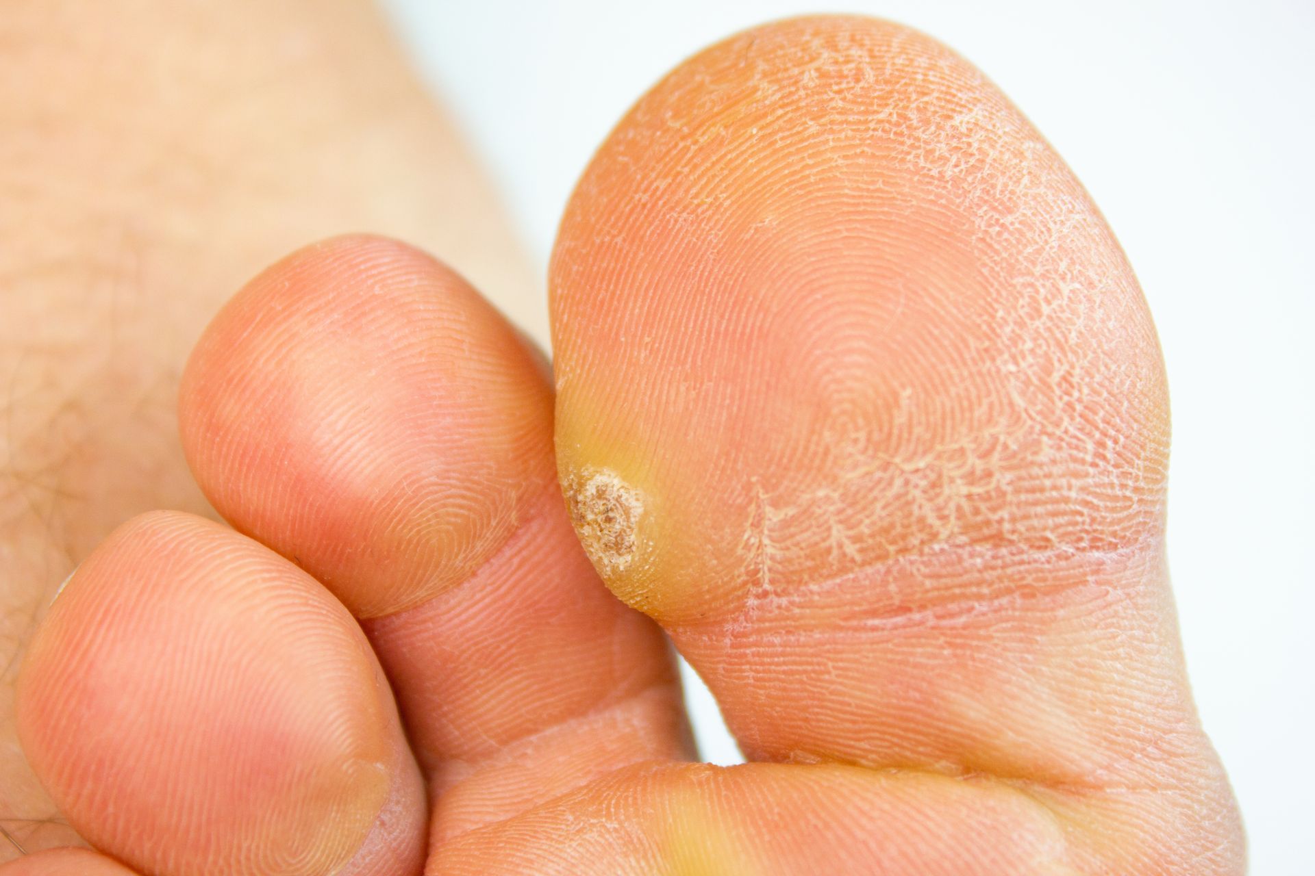 Foot with a wart and dry, cracked skin on the sole and toes.