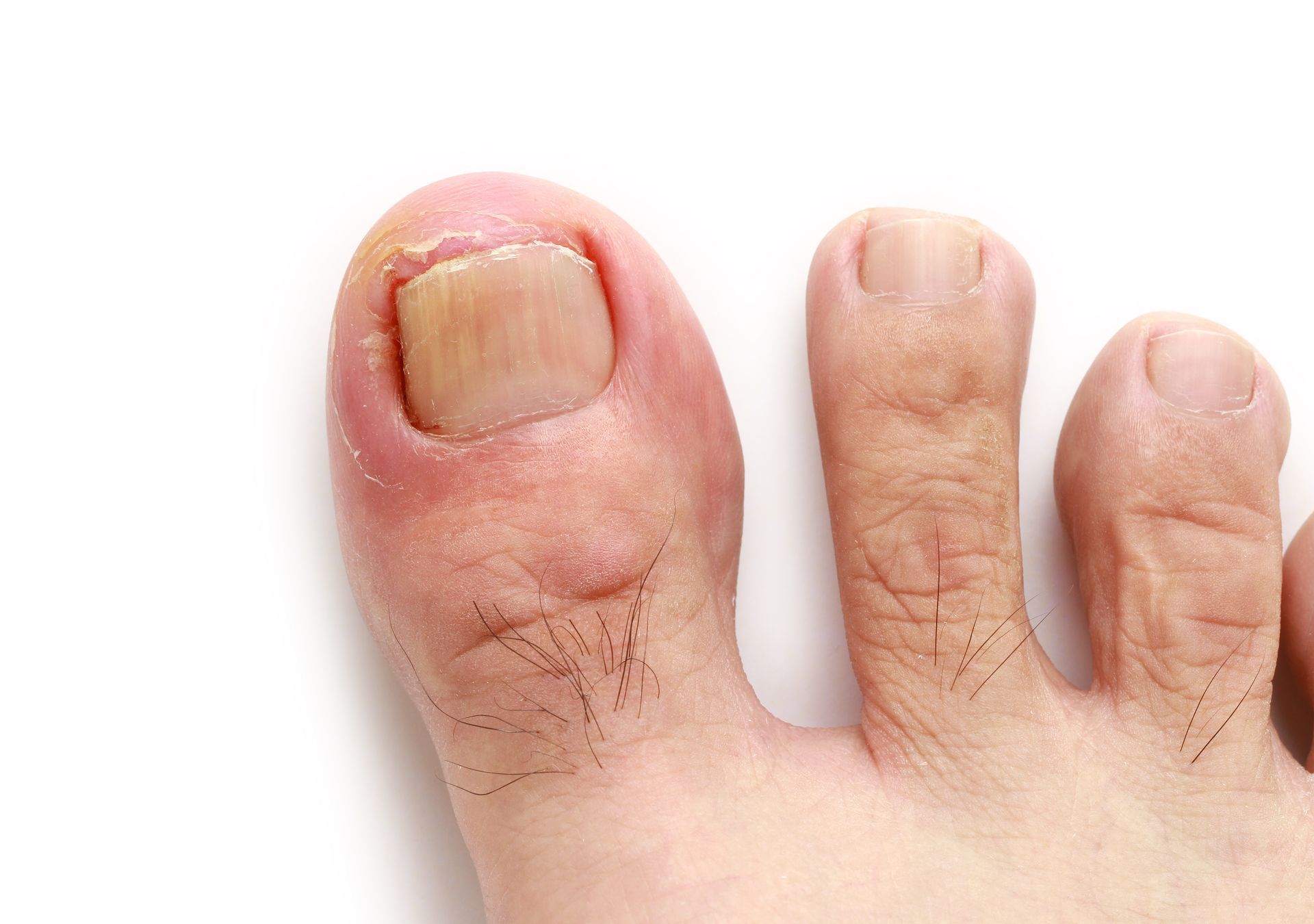 Toe with a discolored and damaged nail, showing signs of a possible fungal infection.
