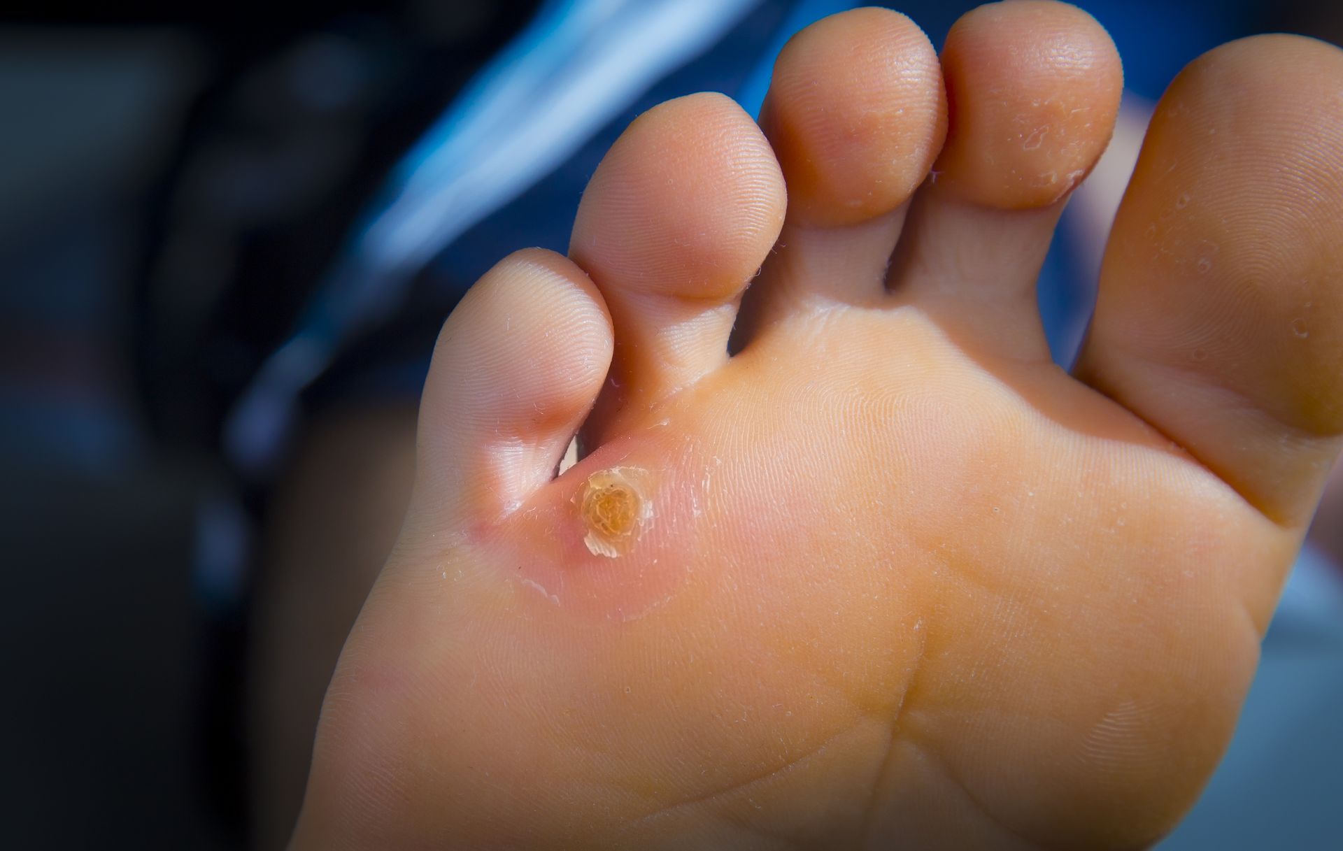 Foot sole with a yellowish wart on the ball of the foot.