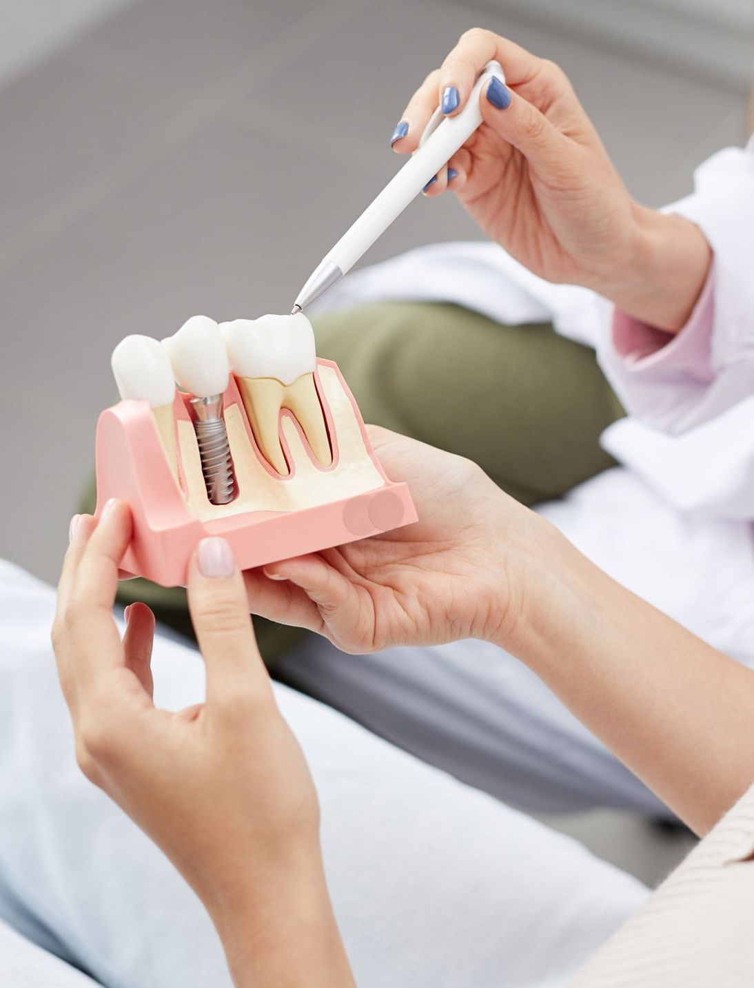 Eine Frau hält ein Modell von Zahnimplantaten in ihren Händen und erhält eine Implantat-Beratung von einer implantologischen Zahnärztin.