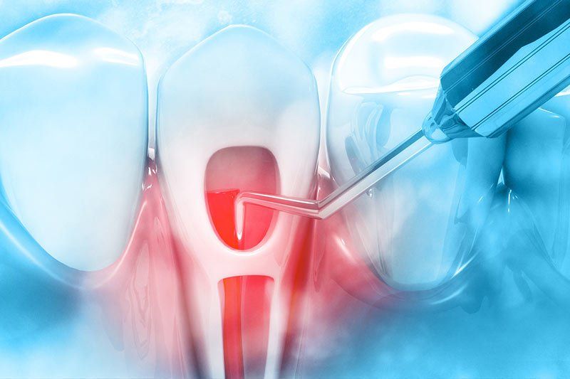 Mit einem Zahnbohrer wird ein Zahn entfernt.