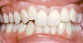 A close up of a person 's teeth with a broken tooth.
