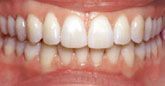 A close up of a person 's teeth with white teeth.