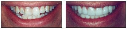 A before and after picture of a person 's teeth.