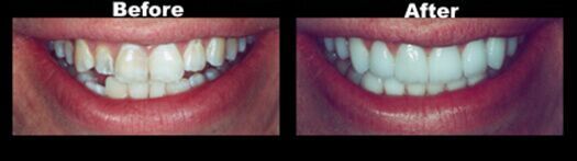 A before and after picture of a person 's teeth